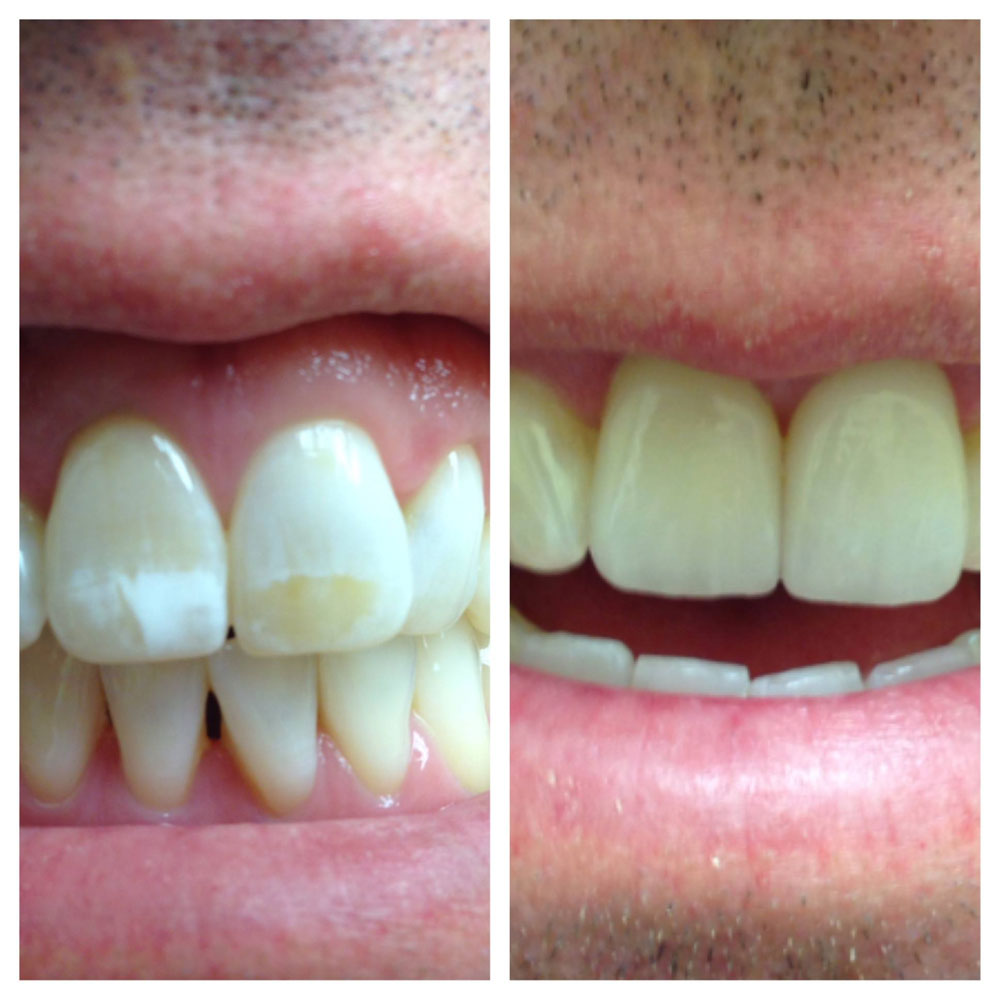 Porcelain-Laminates-Before-After-Photos